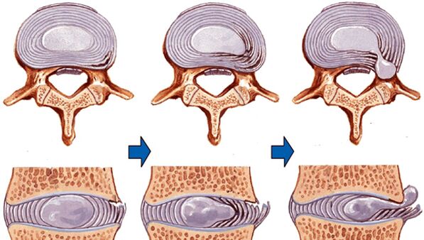 lésion de la colonne vertébrale dans l'ostéochondrose