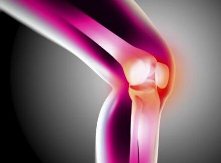 Arthrose déformant