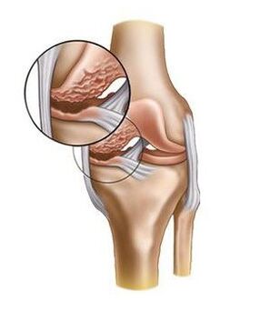 Cartilage endommagé