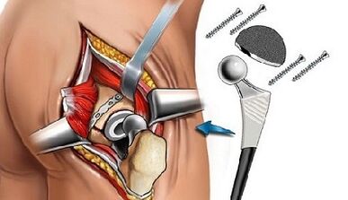 Endoprosthétique pour l'arthrose de la hanche