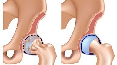 Symptômes d'arthrose de l'articulation de la hanche