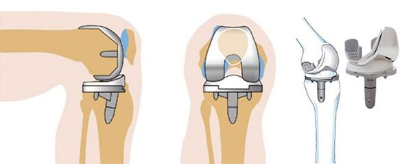 Fonctionnement endoprosthétique de l'articulation du genou pour l'arthrose