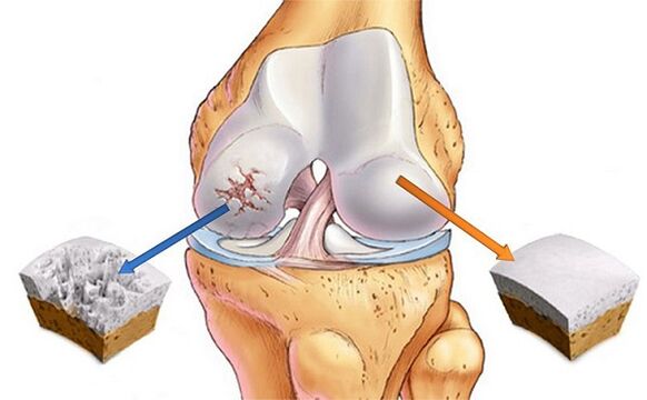 norme et déviation pour l'arthrose de l'articulation du genou