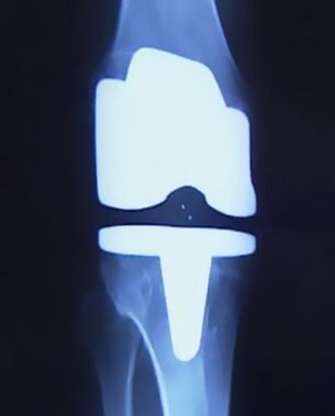 Radiographie d'un genou avec une prothèse artificielle après une arthroplastie