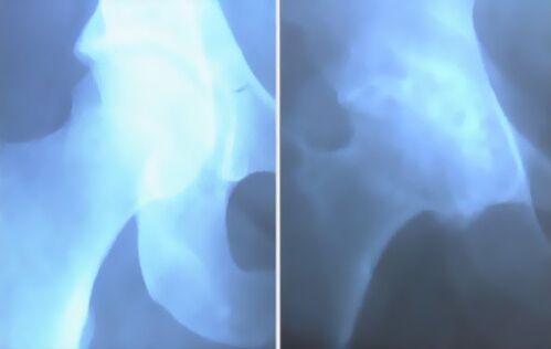 image de l'arthrose de l'articulation du genou