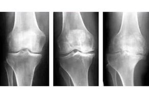 stades de l'arthrose de l'articulation sur une radiographie